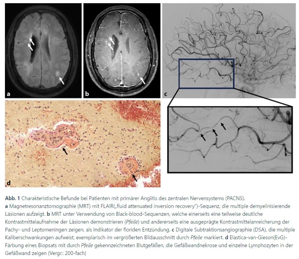 Entzündliche Ursachen von Schlaganfällen – Diagnostik und Therapie    ( İşemik İnsultun İltihabi səbəbləri- Diaqnostika və Müalicəsi)